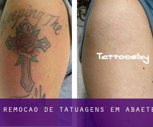 Remoção de tatuagens em Abaeté