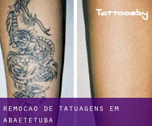 Remoção de tatuagens em Abaetetuba