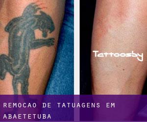 Remoção de tatuagens em Abaetetuba