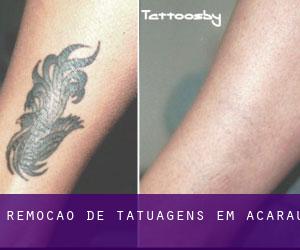 Remoção de tatuagens em Acaraú