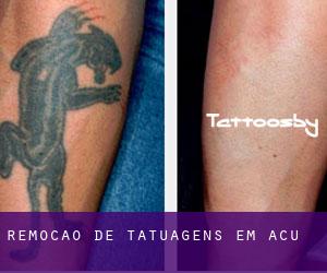 Remoção de tatuagens em Açu