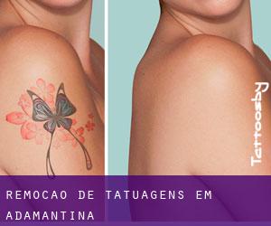Remoção de tatuagens em Adamantina