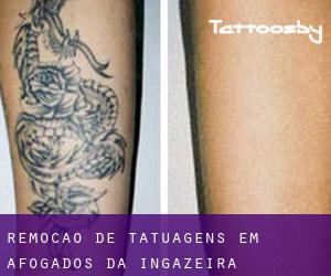 Remoção de tatuagens em Afogados da Ingazeira
