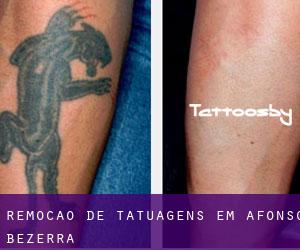 Remoção de tatuagens em Afonso Bezerra