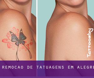 Remoção de tatuagens em Alegre