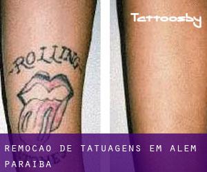 Remoção de tatuagens em Além Paraíba