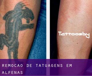 Remoção de tatuagens em Alfenas