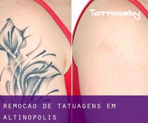 Remoção de tatuagens em Altinópolis