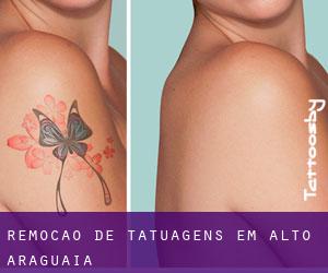 Remoção de tatuagens em Alto Araguaia