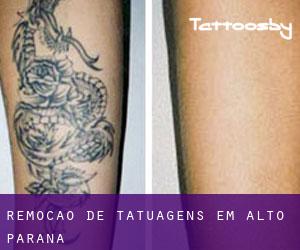 Remoção de tatuagens em Alto Paraná
