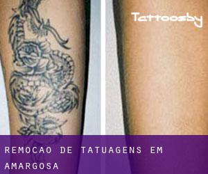 Remoção de tatuagens em Amargosa