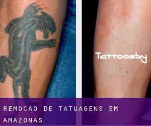 Remoção de tatuagens em Amazonas