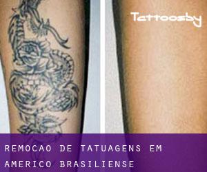 Remoção de tatuagens em Américo Brasiliense