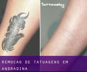 Remoção de tatuagens em Andradina
