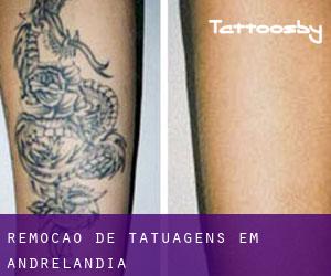 Remoção de tatuagens em Andrelândia