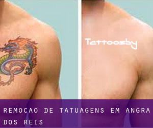 Remoção de tatuagens em Angra dos Reis