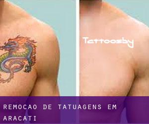 Remoção de tatuagens em Aracati