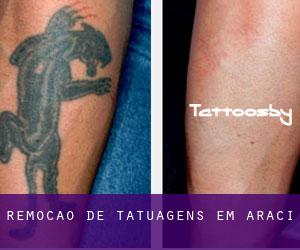 Remoção de tatuagens em Araci