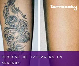 Remoção de tatuagens em Aracruz
