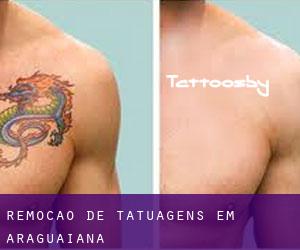 Remoção de tatuagens em Araguaiana