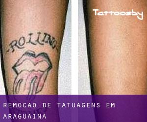 Remoção de tatuagens em Araguaína