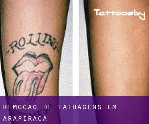 Remoção de tatuagens em Arapiraca