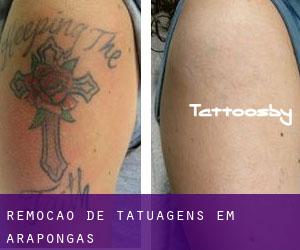 Remoção de tatuagens em Arapongas