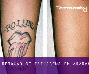 Remoção de tatuagens em Araras