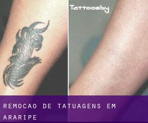 Remoção de tatuagens em Araripe