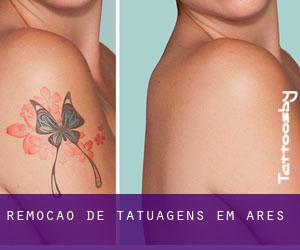 Remoção de tatuagens em Arês