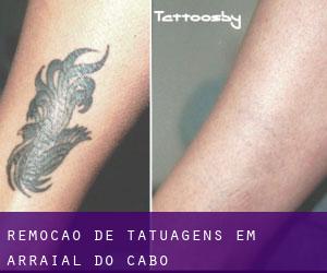 Remoção de tatuagens em Arraial do Cabo