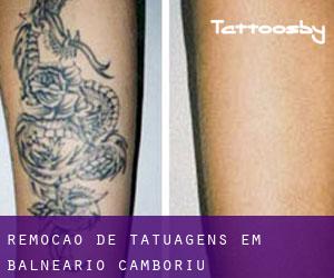 Remoção de tatuagens em Balneário Camboriú