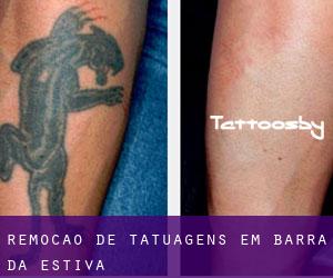 Remoção de tatuagens em Barra da Estiva