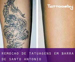 Remoção de tatuagens em Barra de Santo Antônio