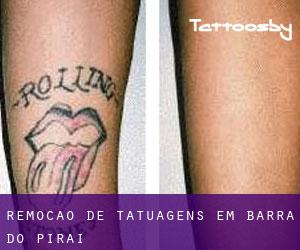 Remoção de tatuagens em Barra do Piraí
