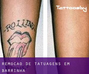 Remoção de tatuagens em Barrinha