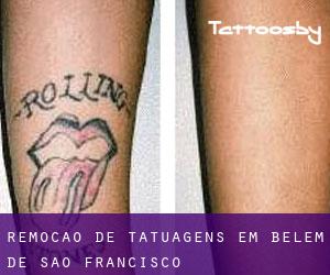 Remoção de tatuagens em Belém de São Francisco