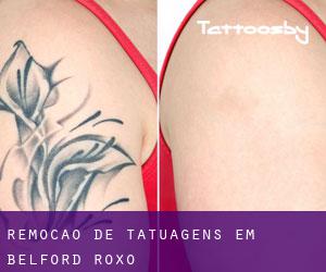 Remoção de tatuagens em Belford Roxo