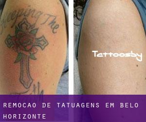 Remoção de tatuagens em Belo Horizonte