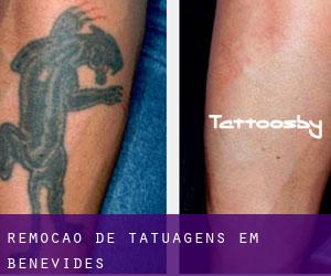 Remoção de tatuagens em Benevides