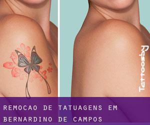 Remoção de tatuagens em Bernardino de Campos