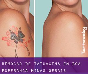 Remoção de tatuagens em Boa Esperança (Minas Gerais)