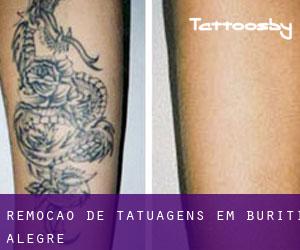 Remoção de tatuagens em Buriti Alegre