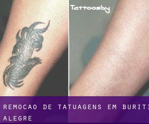 Remoção de tatuagens em Buriti Alegre