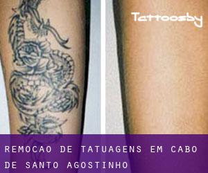 Remoção de tatuagens em Cabo de Santo Agostinho