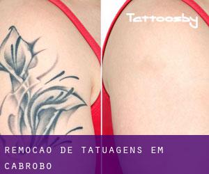 Remoção de tatuagens em Cabrobó
