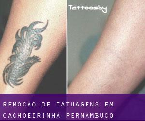 Remoção de tatuagens em Cachoeirinha (Pernambuco)
