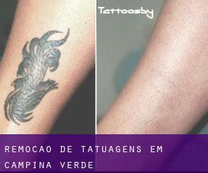 Remoção de tatuagens em Campina Verde