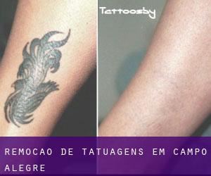 Remoção de tatuagens em Campo Alegre