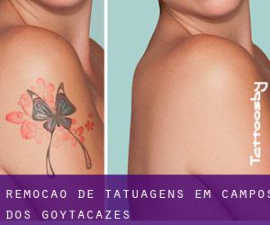Remoção de tatuagens em Campos dos Goytacazes
